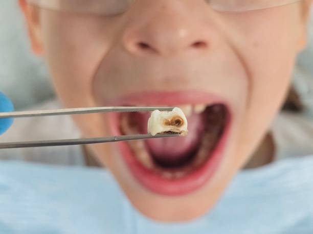 Best Emergency Treatment for Toothache in Carrollton, IL